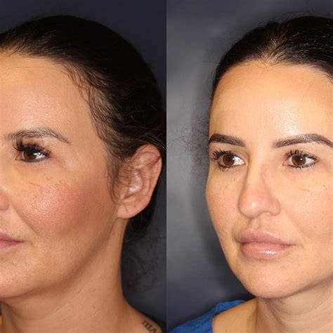 kybella pris|The Kybella Debate: Why Top Plastic Surgeons Are .